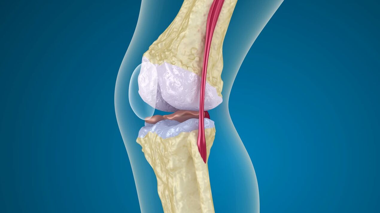 destruction de l'articulation du genou avec arthrose