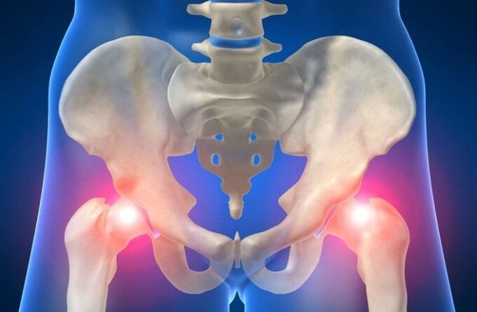 douleurs articulaires de la hanche