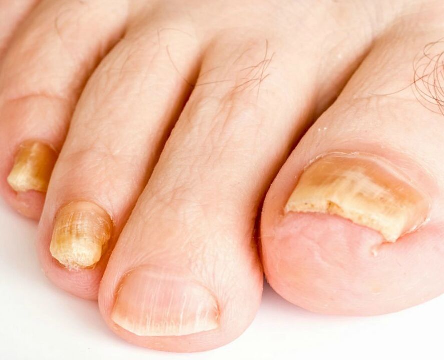 Champignon sur les ongles