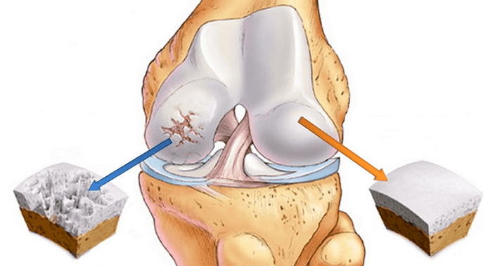 cartilage sain et cartilage affecté par l'arthrose