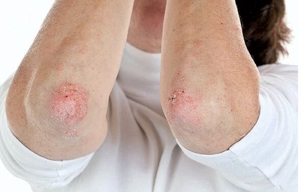 Les personnes atteintes de psoriasis sont sensibles au rhumatisme psoriasique