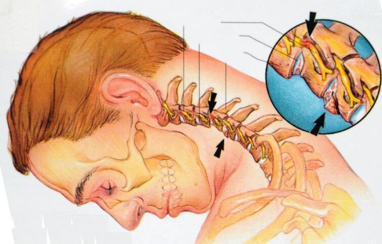 que se passe-t-il avec l'ostéochondrose cervicale