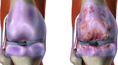 Les principales différences d'arthrite et d'arthrose