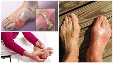 Qu'est-ce que l'arthrite articulaire